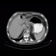Carcinoma of stomach, scirrhotic carcinoma, infiltration of the wall: CT - Computed tomography
