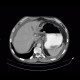 Carcinoma of stomach, scirrhotic carcinoma, infiltration of the wall: CT - Computed tomography