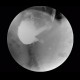 Carcinoma of stomach, scirrhotic carcinoma, infiltration of the wall: RF - Fluoroscopy