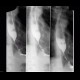 Tumorous stenosis of oesophagus: RF - Fluoroscopy