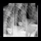 Tumorous stenosis of oesophagus: RF - Fluoroscopy