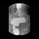 Tumorous stenosis of rectum and sigmoid colon, duplicity, DCBE: RF - Fluoroscopy