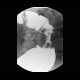 Tumorous stenosis of rectum and sigmoid colon, duplicity, DCBE: RF - Fluoroscopy