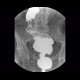 Tumorous stenosis of rectum and sigmoid colon, duplicity, DCBE: RF - Fluoroscopy