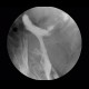 Colorectal cancer, tumorous stenosis of sigmoid colon, placement of stent: RF - Fluoroscopy