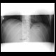 Tumorous stenosis of oesophagus, stent: RF - Fluoroscopy