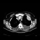 Tumour of chest wall, osteolysis of rib: CT - Computed tomography