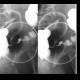 Tumour of sigmoid colon, irrigography: RF - Fluoroscopy