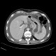 Tumour of stomach, ascites: CT - Computed tomography