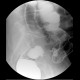 Tumorous stenosis of the sigmoid colon: RF - Fluoroscopy