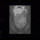 Ulcerative colitis, enterography: CT - Computed tomography