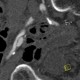 Ulcerated plaque of external iliac artery: CT - Computed tomography