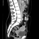 Umbilical metastasis, Sister Mary Joseph syndrome: CT - Computed tomography