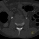 Uretherolithiasis, urolithiasis, ureteric stone, hydronephrosis, unenhanced: CT - Computed tomography