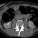 Uretherolithiasis, urolithiasis, ureteric stone, hydronephrosis, unenhanced: CT - Computed tomography