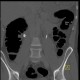 Uretherolithiasis, urolithiasis, ureteric stone, hydronephrosis, unenhanced: CT - Computed tomography