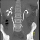 Uretherolithiasis, urolithiasis, ureteric stone, hydronephrosis, excretory phase: CT - Computed tomography