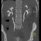 Uretherolithiasis, urolithiasis, ureteric stone, hydronephrosis, excretory phase: CT - Computed tomography