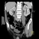 Uretherolithiasis, urolithiasis, ureteric stone, hydronephrosis, excretory phase: CT - Computed tomography