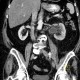 Uretherolithiasis in pyeloureteral junction, PUJ: CT - Computed tomography