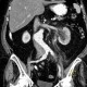 Uretherolithiasis in pyeloureteral junction, PUJ, hydronephrosis: CT - Computed tomography