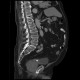 Urocystolithiasis, stone in urinary bladder: CT - Computed tomography
