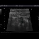 Acute appendicitis: US - Ultrasound