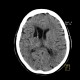 Occlusion of middle cerebral artery, MCA, collateral flow, postischemic changes: CT - Computed tomography