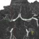 Occlusion of middle cerebral artery, MCA, collateral flow, postischemic changes: CT - Computed tomography