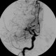 Occlusion of middle cerebral artery, MCA, collateral flow, postischemic changes: AG - Angiography