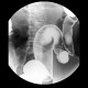 Ulcerative colitis, barium enema, irrigography: RF - Fluoroscopy