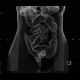 Ulcerative colitis, CT colonography: CT - Computed tomography