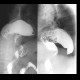 Upside-down stomach: RF - Fluoroscopy