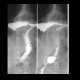 Upside-down stomach: RF - Fluoroscopy