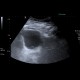 Ureterocoele, outpouching of ureter into bladder: US - Ultrasound