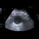 Ureterocoele, outpouching of ureter into bladder: US - Ultrasound