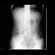 Ureterolithiasis, inapparent: X-ray - Plain radiograph
