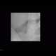 Ureterolithiasis, inapparent: X-ray - Plain radiograph