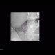 Ureterolithiasis, inapparent: X-ray - Plain radiograph