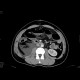 Urinoma: CT - Computed tomography
