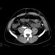 Urinoma: CT - Computed tomography