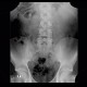 Ureterolithiasis, urolithiasis, hydronephrosis, grade II: X-ray - Plain radiograph