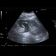 Ureterolithiasis, urolithiasis, hydronephrosis, grade II: US - Ultrasound