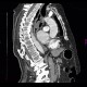 Leiomyoma of esophagus: CT - Computed tomography