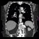 Leiomyoma of esophagus: CT - Computed tomography