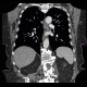 Leiomyoma of esophagus: CT - Computed tomography