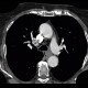 Leiomyoma of esophagus: CT - Computed tomography