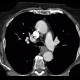 Leiomyoma of esophagus: CT - Computed tomography