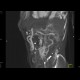 Obliteration of the coeliac trunk and superior mesenteric artery, massive collateral flow: CT - Computed tomography