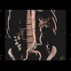 Obliteration of the coeliac trunk and superior mesenteric artery, massive collateral flow: CT - Computed tomography